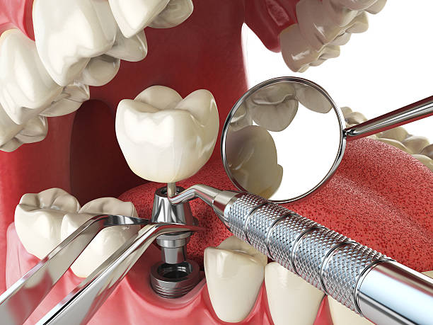 Emergency Dental Filling Replacement in CA